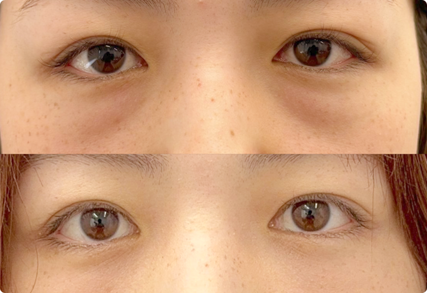 難しい色グマも一目瞭然 こだわり抜いた脂肪注入