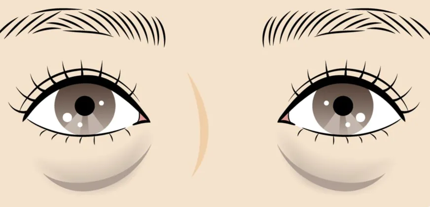 大阪 クマ取り,大阪 クマ治療,大阪 裏ハムラ,大阪 脂肪注入,クマ取りダウンタイム,クマ取り 大阪,クマ治療 大阪,裏ハムラ 大阪,脂肪注入 大阪,クマ取り,クマ治療,裏ハムラ,脂肪注入,ダウンタイム,大阪,心斎橋,専門院,美容外科,木田ビューティークリニック