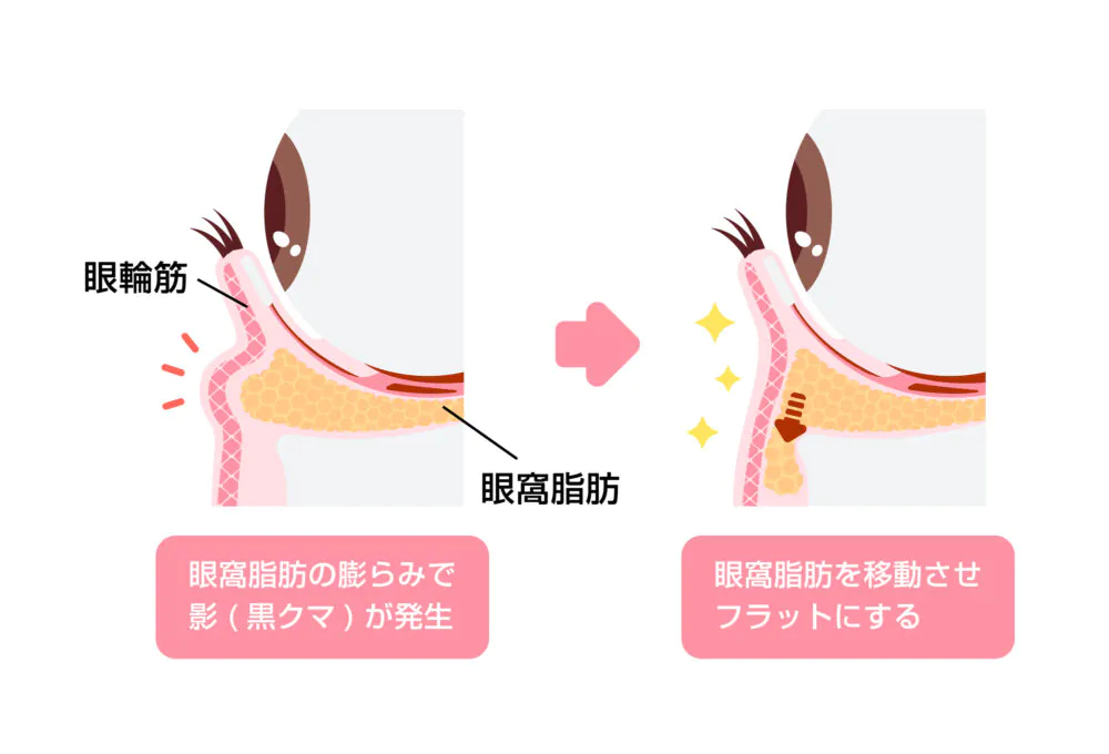 大阪 クマ取り,大阪 クマ治療,大阪 裏ハムラ,大阪 脂肪注入,クマ取りダウンタイム,クマ取り 大阪,クマ治療 大阪,裏ハムラ 大阪,脂肪注入 大阪,クマ取り,クマ治療,裏ハムラ,脂肪注入,ダウンタイム,大阪,心斎橋,専門院,美容外科,木田ビューティークリニック